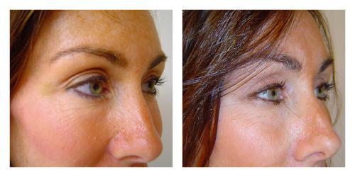 Blepharoplasty result at Smith Plastic Surgery in Las Vegas, NV