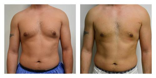 Gynecomastia Surgery result at Smith Plastic Surgery in Las Vegas, NV