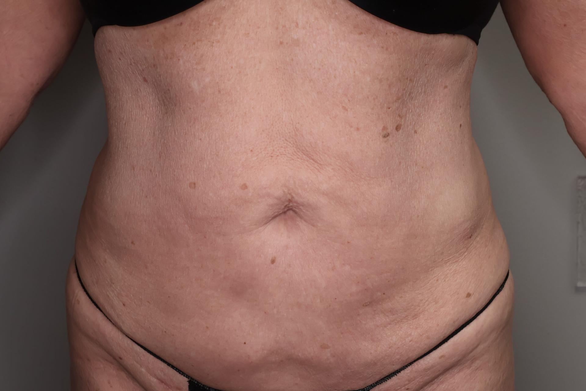 Gilson Plastic Surgery liposuction after — Portland, OR