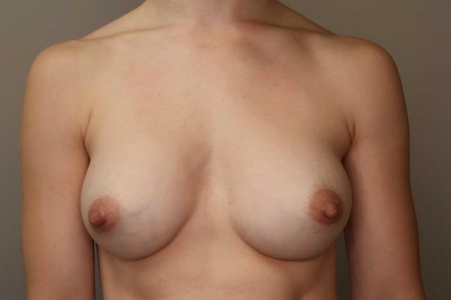 Breast Augmentation after at Gilson Plastic Surgery in Portland, OR