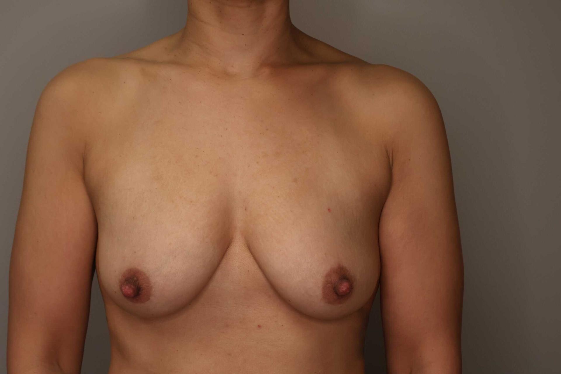 Gilson Plastic Surgery breast fat transfer after — Portland, OR