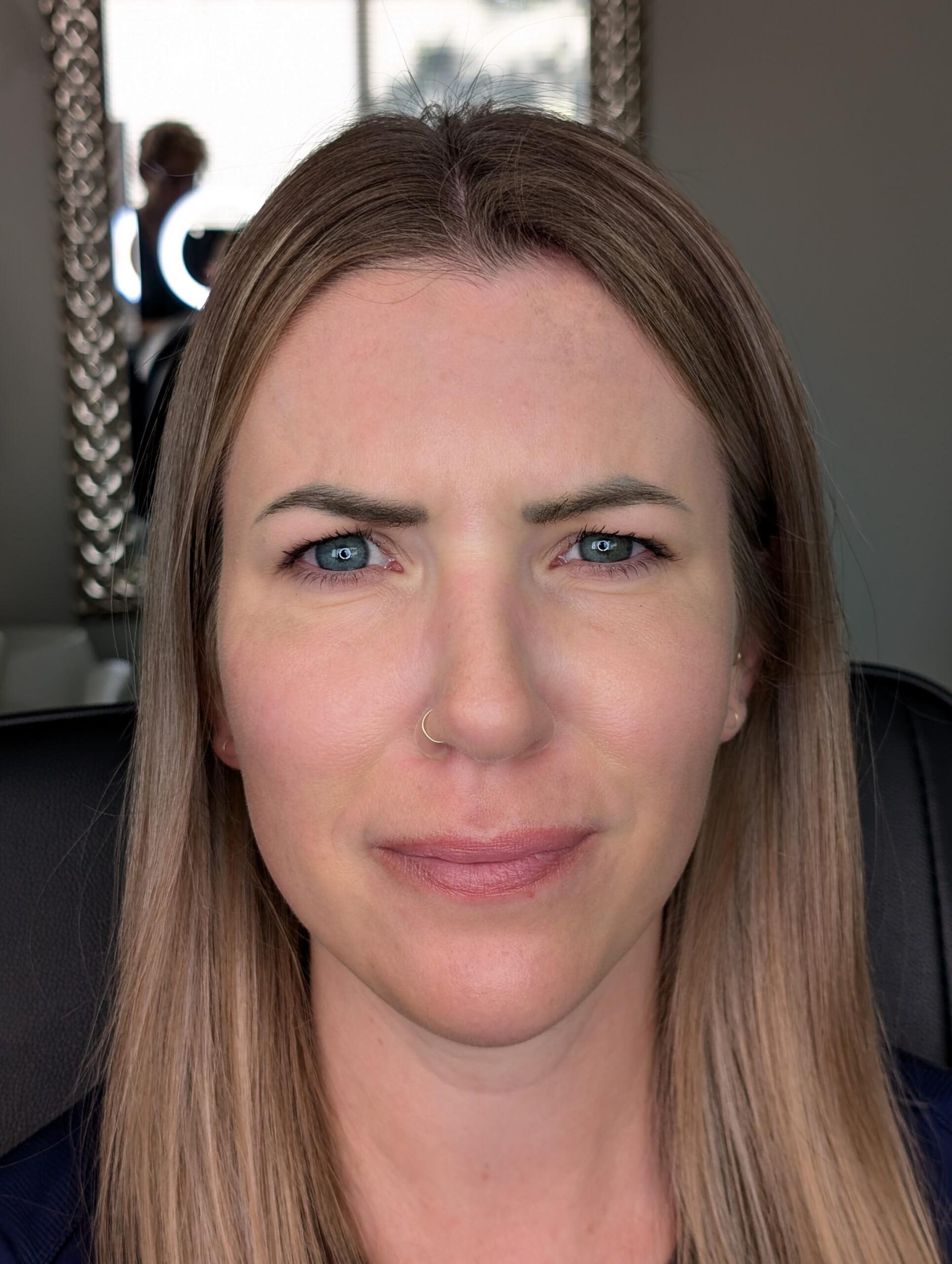 Gilson Plastic Surgery botox after — Portland, OR