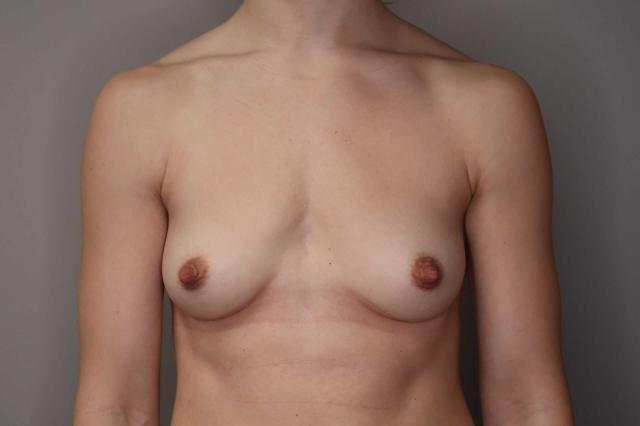 Breast Augmentation before at Gilson Plastic Surgery in Portland, OR