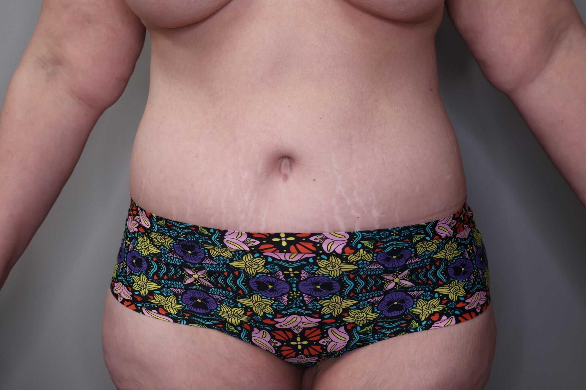 Gilson Plastic Surgery tummy tuck after — Portland, OR