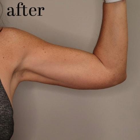 Gilson Plastic Surgery liposuction after — Portland, OR