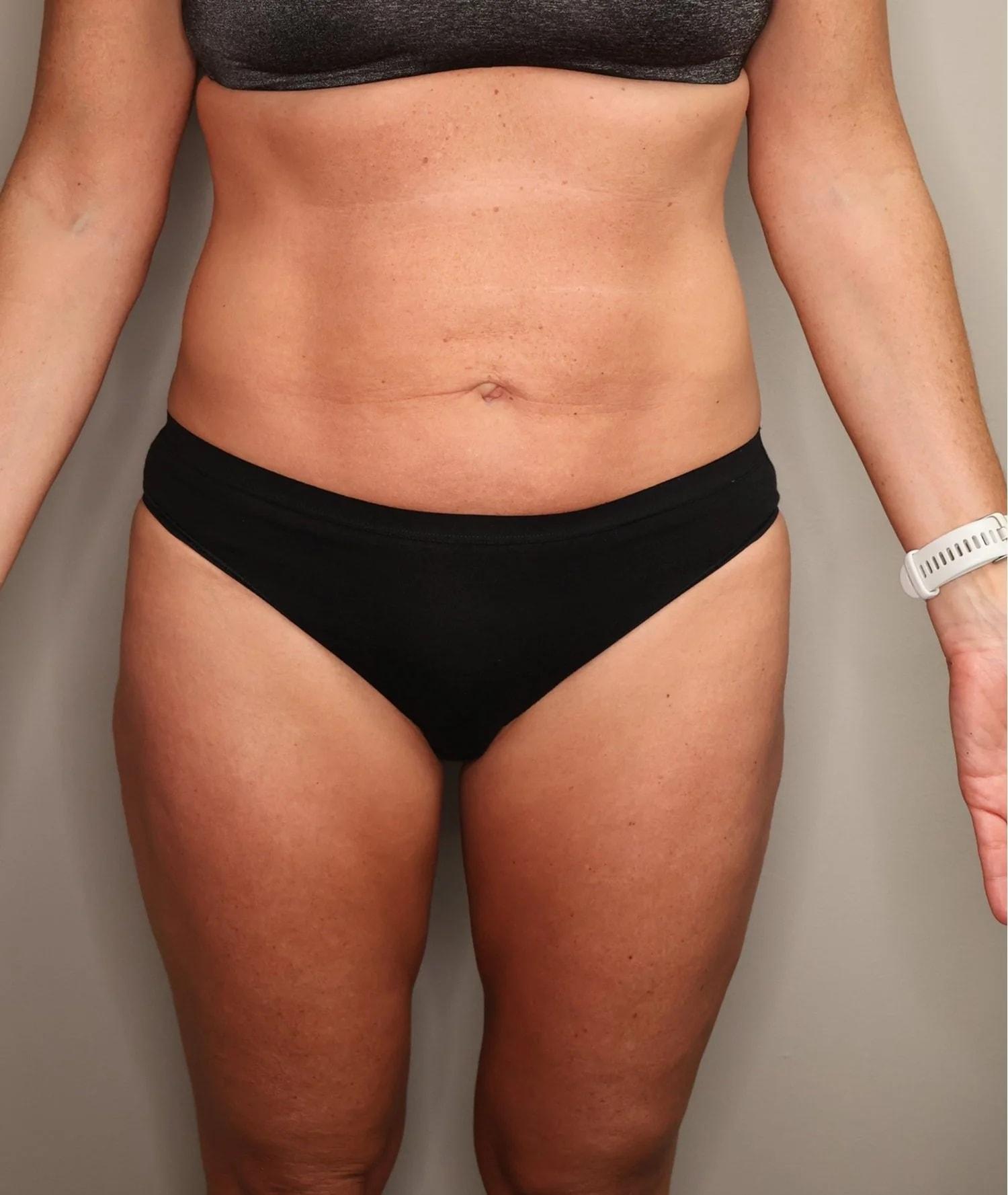 Gilson Plastic Surgery liposuction after — Portland, OR