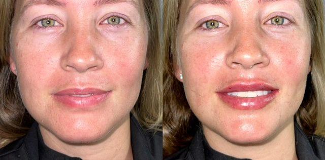 Lip Filler result at Ferrara Medical Aesthetics in Marietta, GA