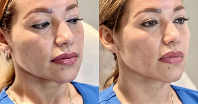 Dermal Fillers result at Ferrara Medical Aesthetics in Marietta, GA
