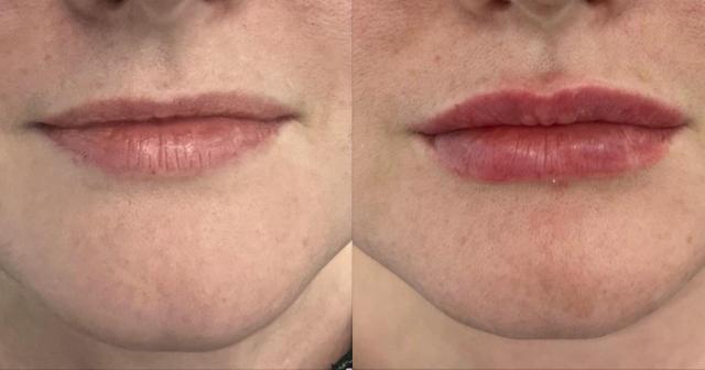 Lip Filler result at Ferrara Medical Aesthetics in Marietta, GA