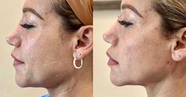 Jawline Filler result at Ferrara Medical Aesthetics in Marietta, GA
