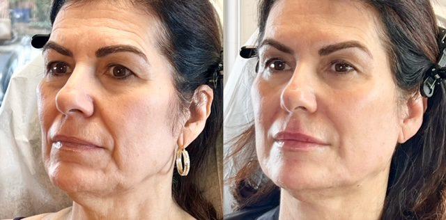 Facelift result at Ferrara Medical Aesthetics in Marietta, GA