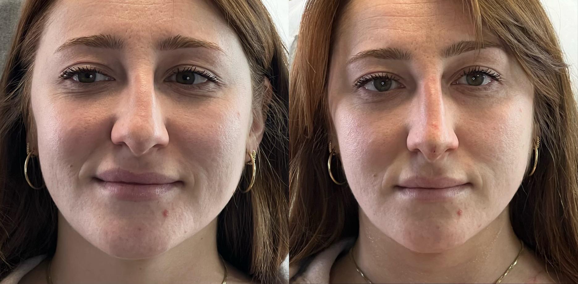 Ferrara Medical Aesthetics result — Marietta, GA
