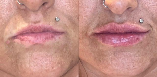 Lip Filler result at Ferrara Medical Aesthetics in Marietta, GA