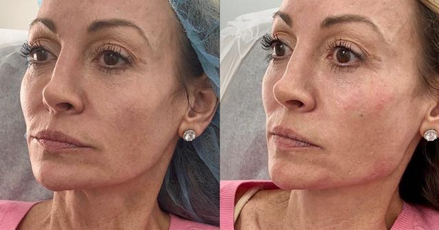 Jawline Filler result at Ferrara Medical Aesthetics in Marietta, GA
