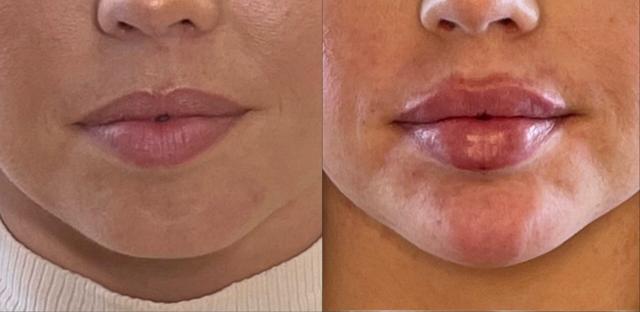 Lip Filler result at Ferrara Medical Aesthetics in Marietta, GA