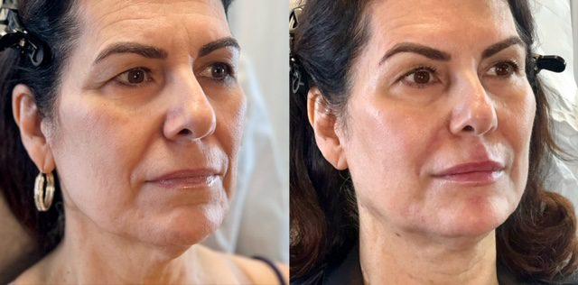 Deep Plane Facelift result at Ferrara Medical Aesthetics in Marietta, GA