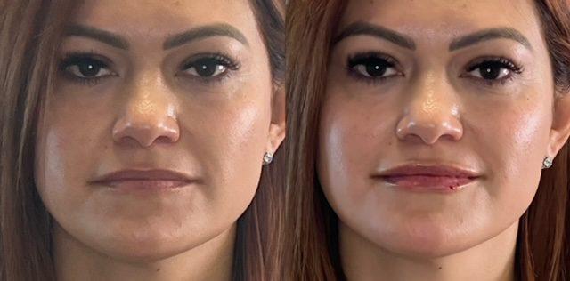 Ferrara Medical Aesthetics result — Marietta, GA