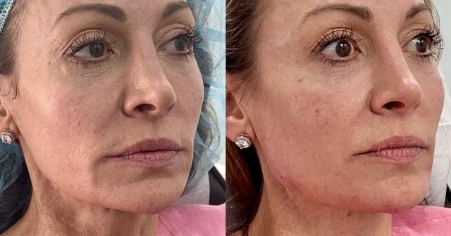 Jawline Filler result at Ferrara Medical Aesthetics in Marietta, GA