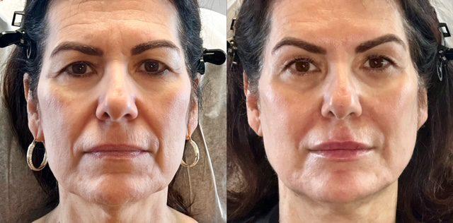 Deep Plane Facelift result at Ferrara Medical Aesthetics in Marietta, GA