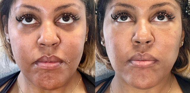 Ferrara Medical Aesthetics result — Marietta, GA