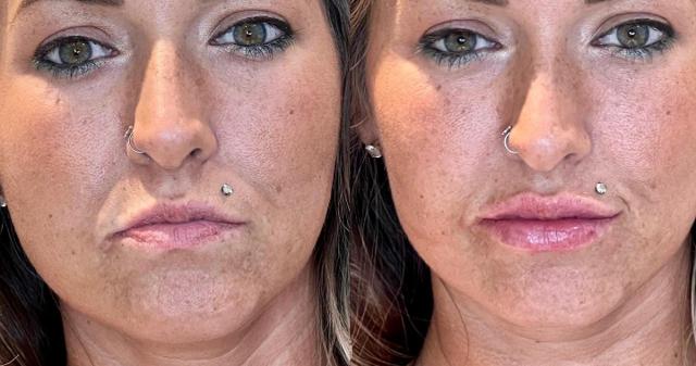Lip Filler result at Ferrara Medical Aesthetics in Marietta, GA
