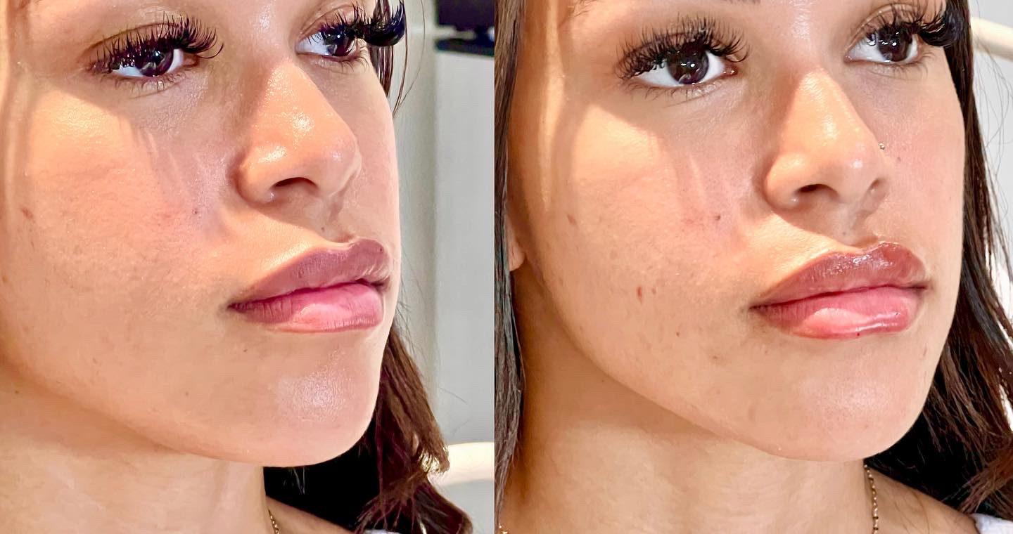 Ferrara Medical Aesthetics result — Marietta, GA