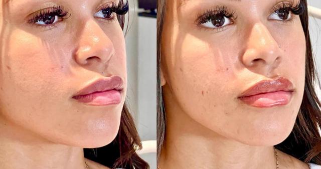 Lip Filler result at Ferrara Medical Aesthetics in Marietta, GA