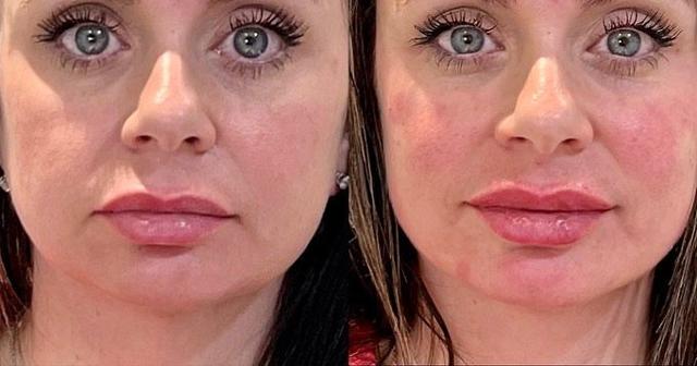 Lip Filler result at Ferrara Medical Aesthetics in Marietta, GA