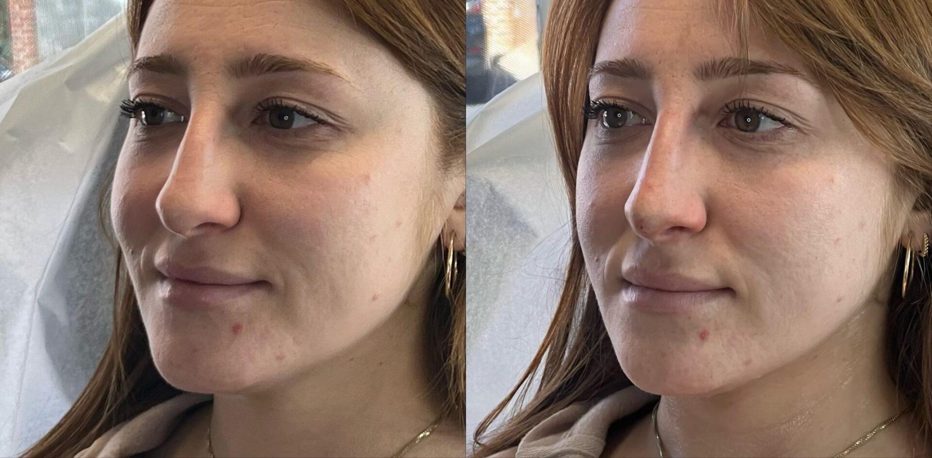 Ferrara Medical Aesthetics result — Marietta, GA