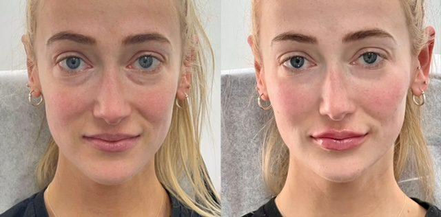 Lip Filler result at Ferrara Medical Aesthetics in Marietta, GA