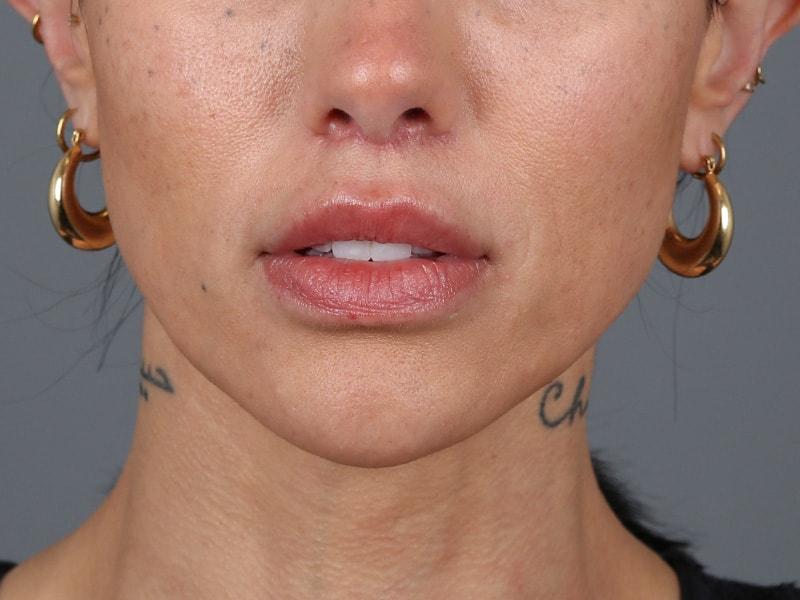 Michael Kim, MD lip lift after — Portland, OR