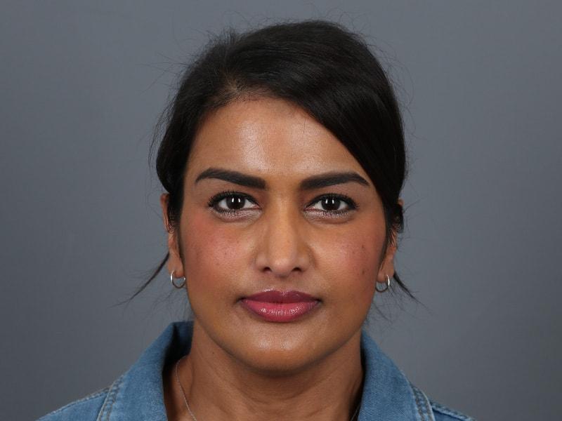 Michael Kim, MD rhinoplasty after — Portland, OR