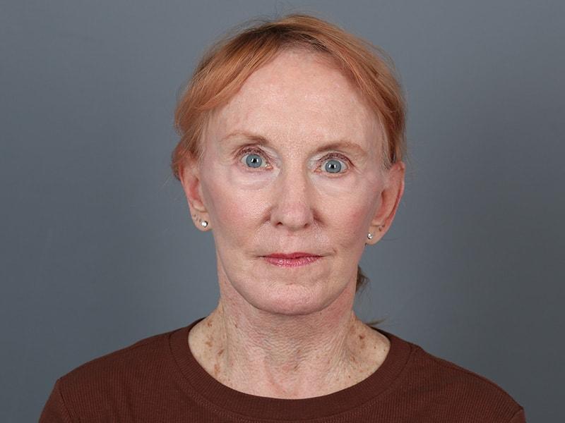 Michael Kim, MD facelift after — Portland, OR