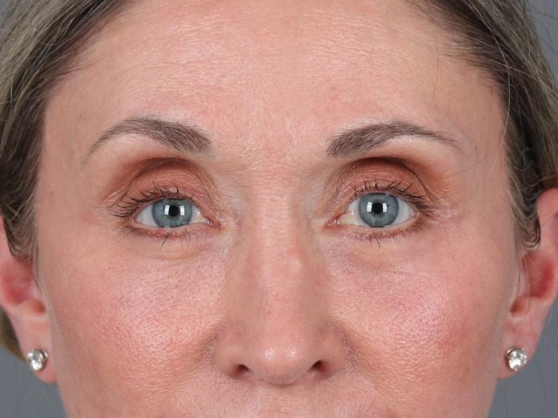 Michael Kim, MD eyelid lift after — Portland, OR