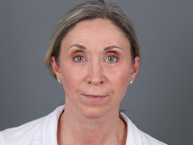 Brow Lift after at Michael Kim, MD in Portland, OR