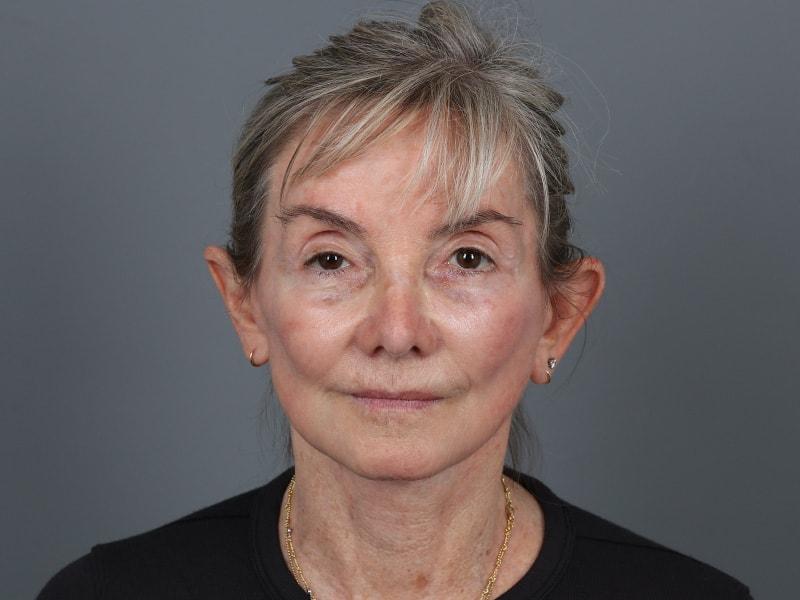 Michael Kim, MD facelift after — Portland, OR