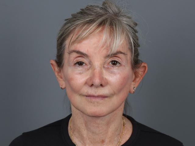 Neck Lift after at Michael Kim, MD in Portland, OR