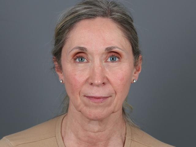 Brow Lift before at Michael Kim, MD in Portland, OR
