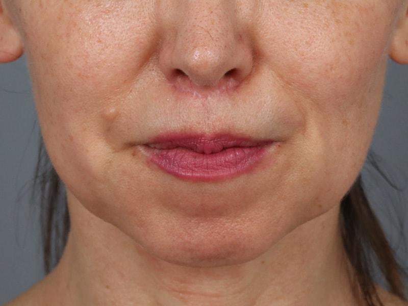 Michael Kim, MD lip lift after — Portland, OR