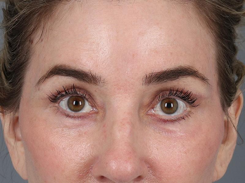 Michael Kim, MD eyelid lift after — Portland, OR
