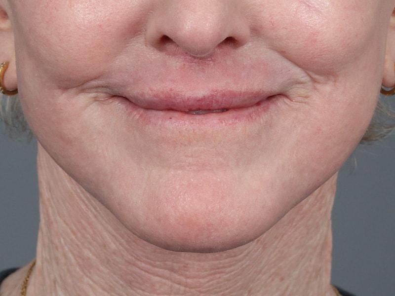 Michael Kim, MD lip lift after — Portland, OR