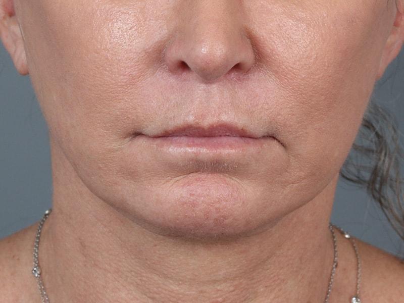 Michael Kim, MD lip lift after — Portland, OR