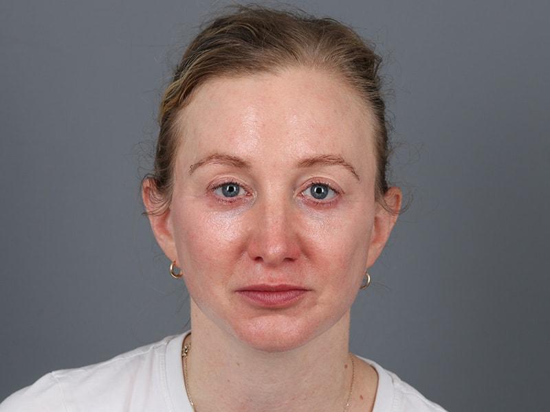Michael Kim, MD facelift after — Portland, OR