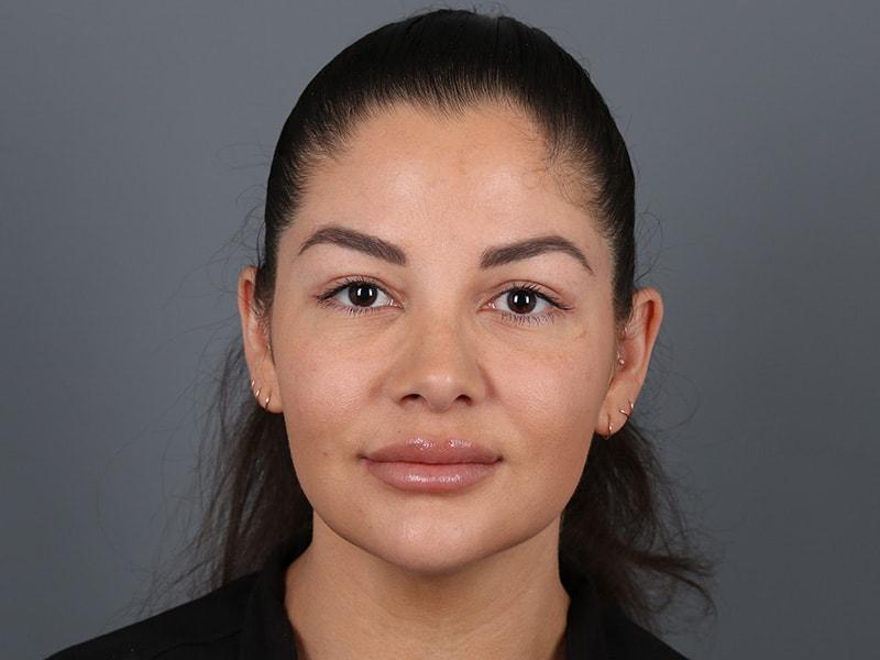 Michael Kim, MD rhinoplasty after — Portland, OR
