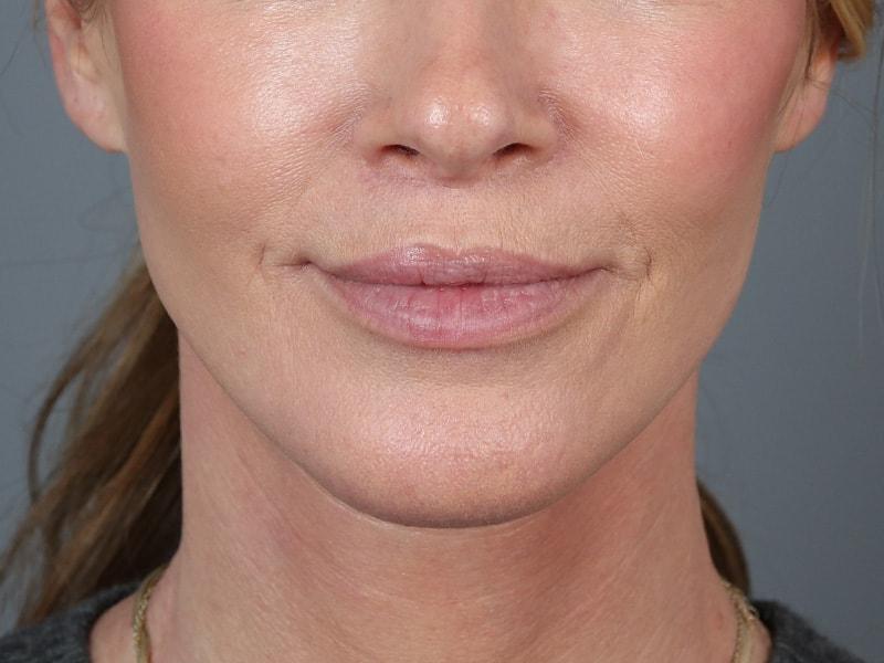 Michael Kim, MD lip lift after — Portland, OR