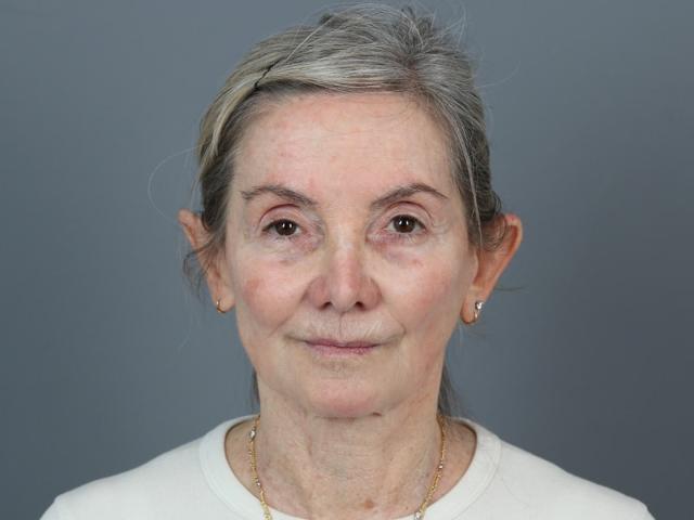 Neck Lift before at Michael Kim, MD in Portland, OR