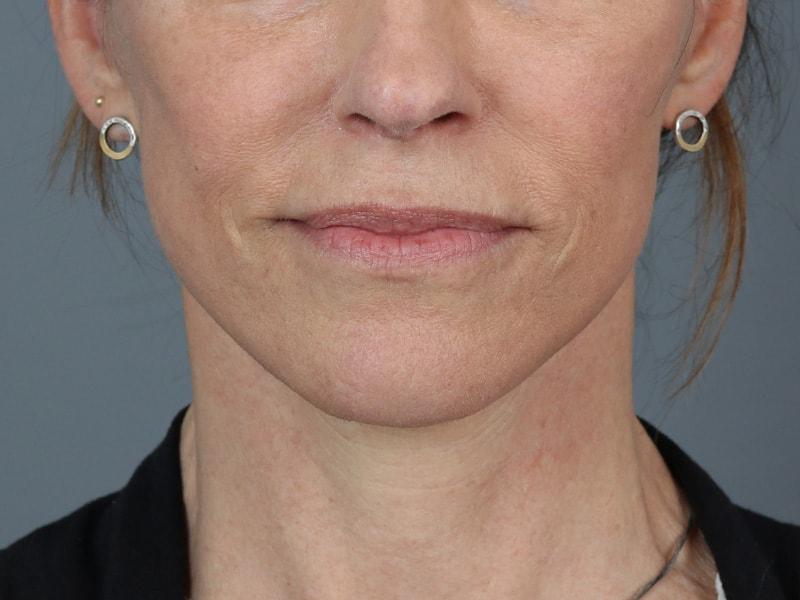 Michael Kim, MD facelift after — Portland, OR