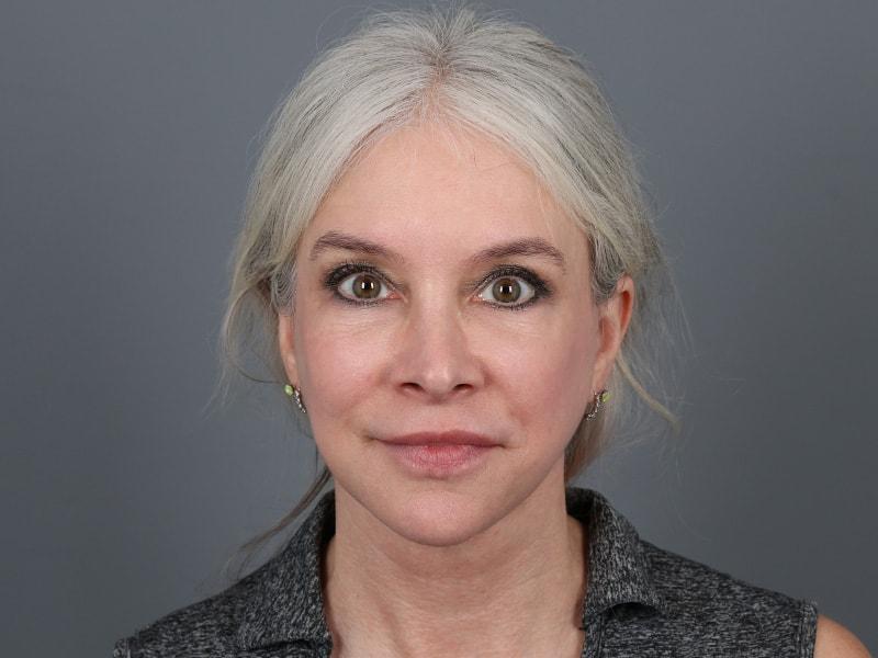 Michael Kim, MD facelift after — Portland, OR