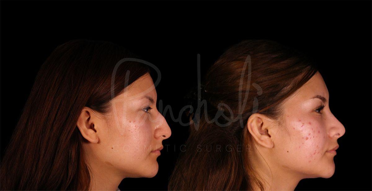 Pancholi Cosmetic Surgery rhinoplasty result — Las Vegas, NV