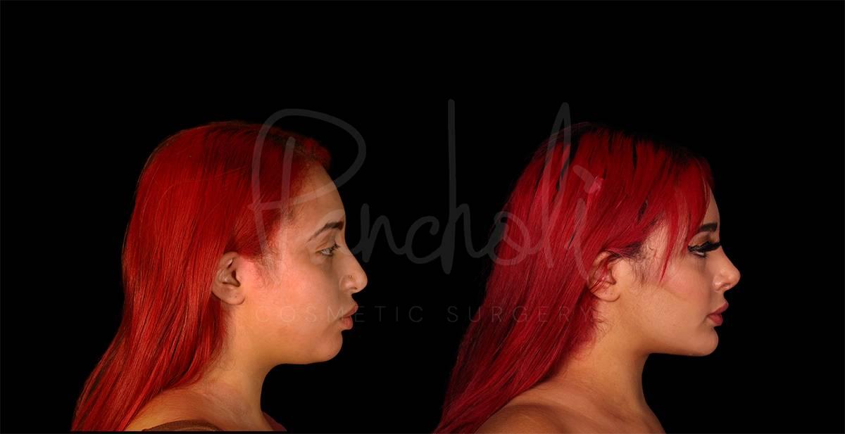 Pancholi Cosmetic Surgery neck lift result — Las Vegas, NV